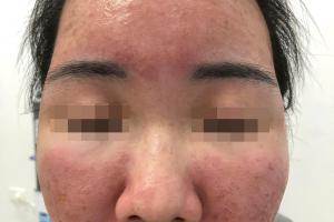 Cháy da bỏng rát sau khi dùng kem siêu chống nắng mua qua mạng