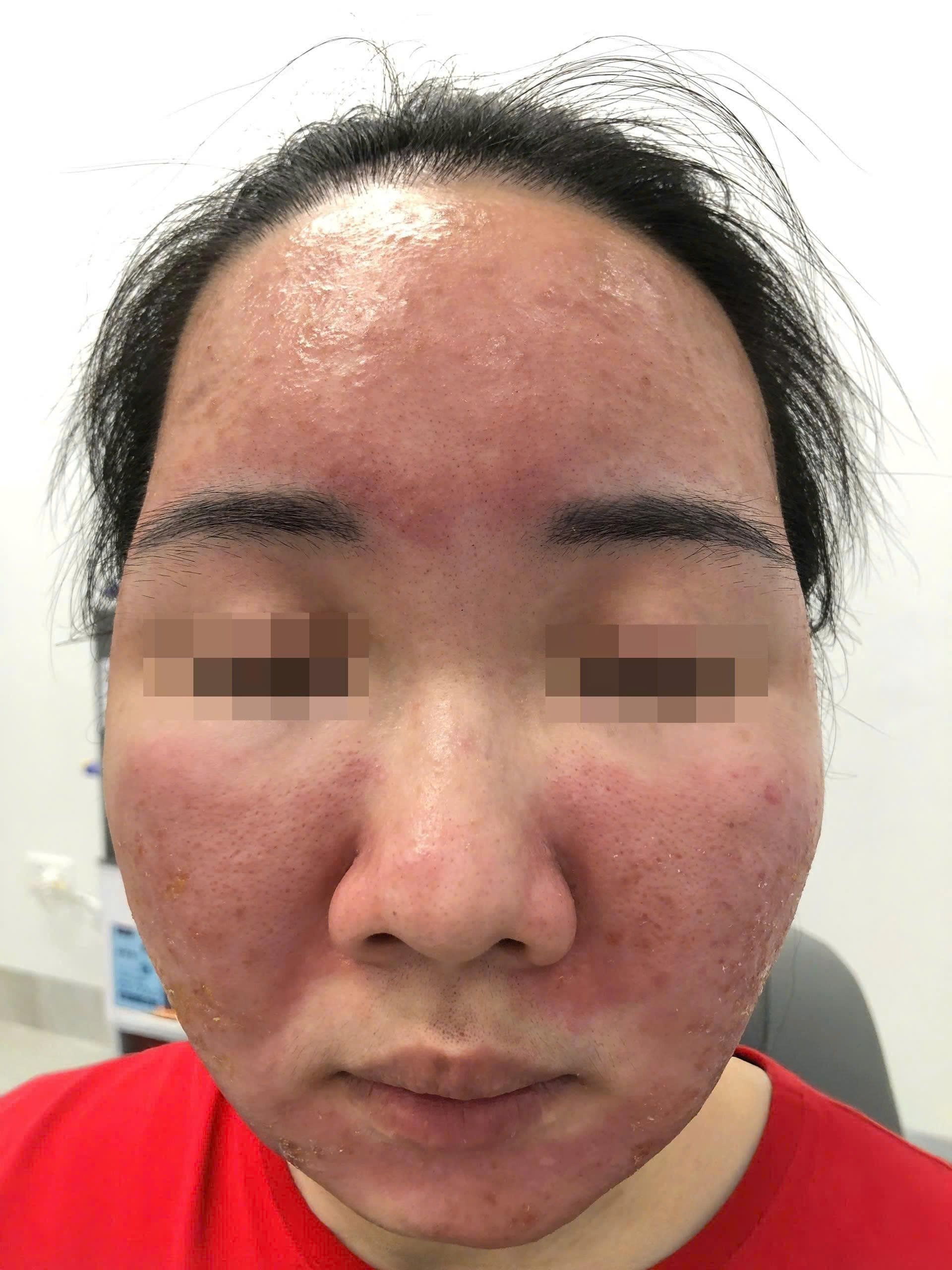 Cháy da bỏng rát sau khi dùng kem siêu chống nắng mua qua mạng
